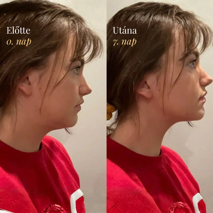 Nyirokáramlást Serkentő Arckefe - Burelin™