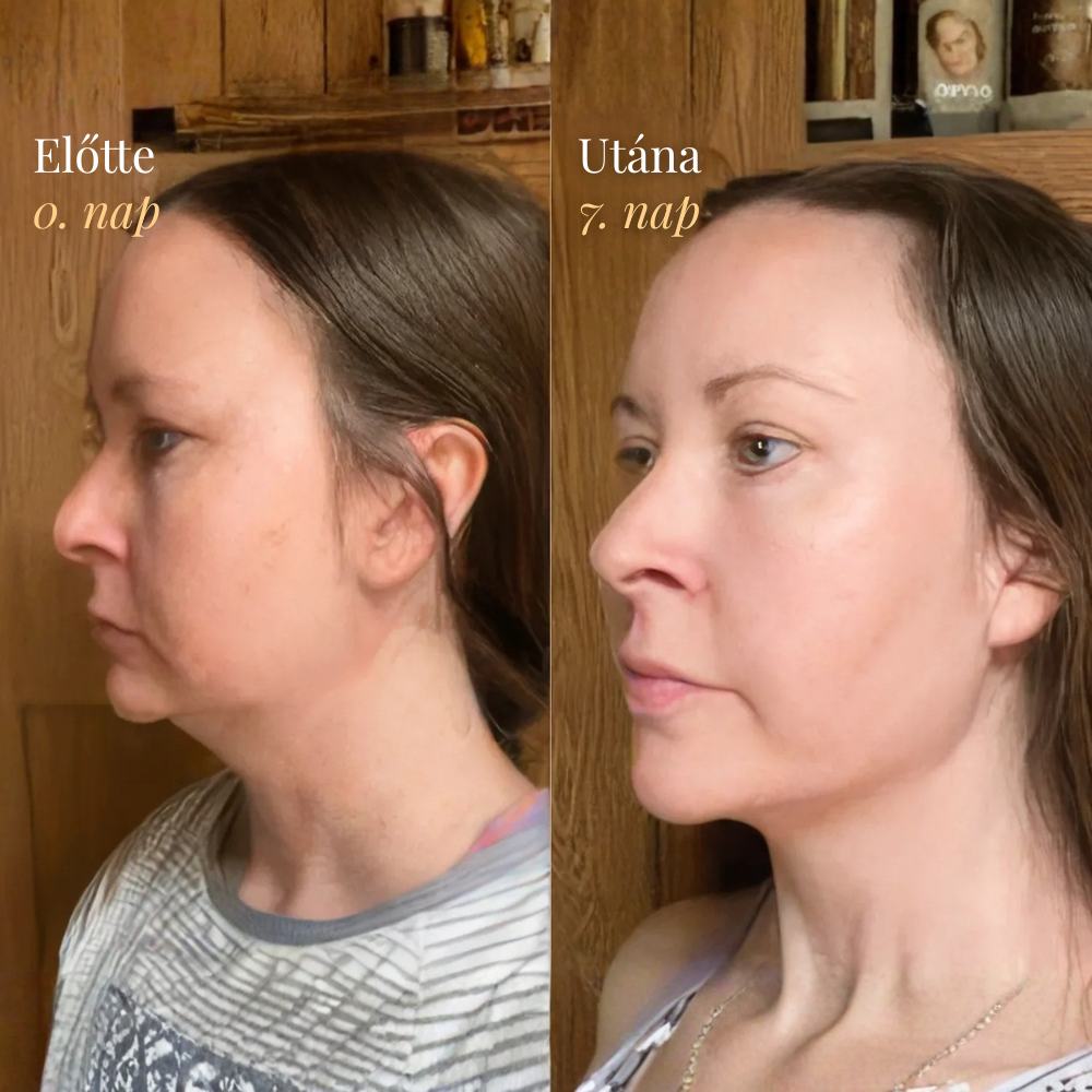 Nyirokáramlást Serkentő Arckefe - Burelin™